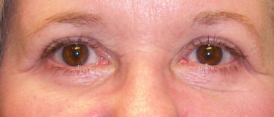 A close-up image showing a patient's eyes before and after ptosis and blepharoplasty surgery. The left eye exhibits drooping eyelids (ptosis), while the right eye appears rejuvenated and lifted after the surgery.